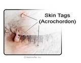 Skin Tags